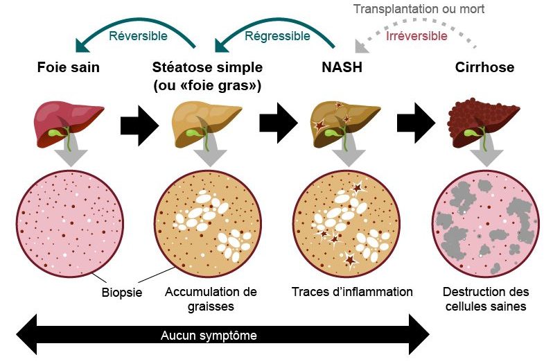 La stéatose hépatique non-alcoolique (NAFLD)